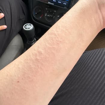 Mustela Alerji Yaptı Döküntü Ve Yanma Oldu