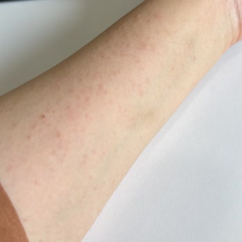 Mustela Alerji Yaptı Döküntü Ve Yanma Oldu