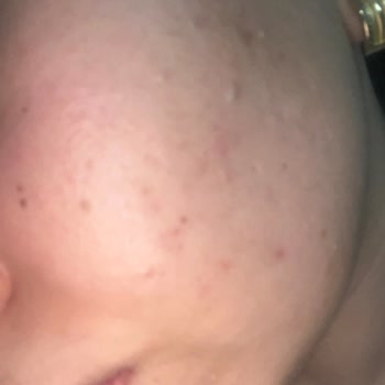 Watsons Alerji Yapan Ürün Ve İade Sorunu