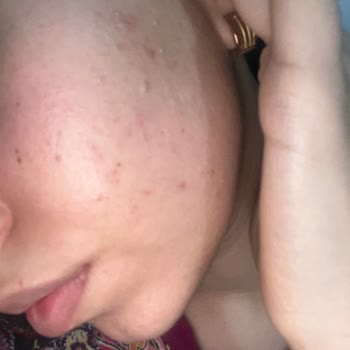 Watsons Alerji Yapan Ürün Ve İade Sorunu