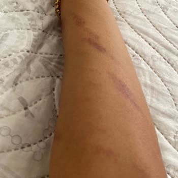 Melisa Soydemir Güzellik Yapılan Lazer Sonrası Vücudumda Oluşan Yanıklar