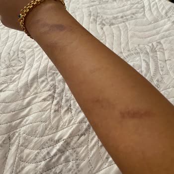 Melisa Soydemir Güzellik Yapılan Lazer Sonrası Vücudumda Oluşan Yanıklar