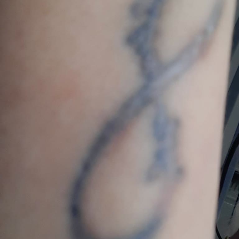 Şova Beauty Center Tırnak Dövme Silme İşlemi Başarısız