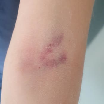 Lösante Hastanesi Kan Aldırma Özensizliği