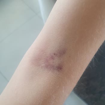 Lösante Hastanesi Kan Aldırma Özensizliği