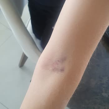 Lösante Hastanesi Kan Aldırma Özensizliği