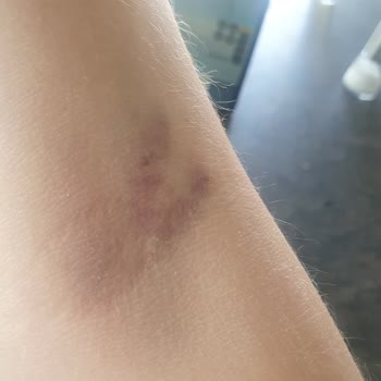 Lösante Hastanesi Kan Aldırma Özensizliği