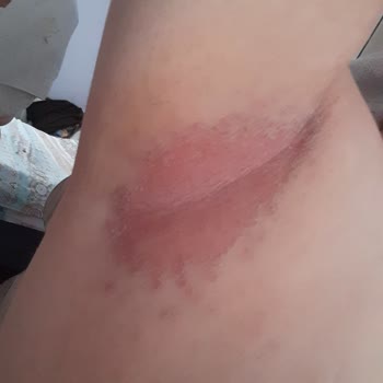 Rexona Deodorant Yanığı Ve Kaşıntı Şikayeti