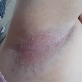 Rexona Deodorant Yanığı Ve Kaşıntı Şikayeti