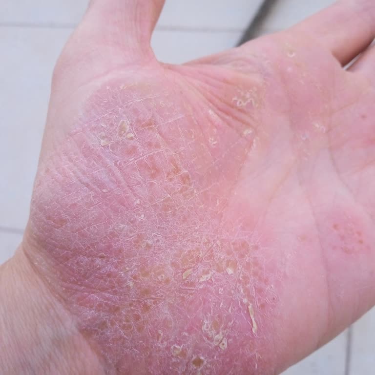 Hasırcı Aktariye Egzamam Çoğaldı İlaç Değil Sadece Su Krem