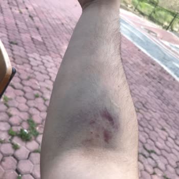 Türk Kızılay Kan Bağışı Sonucu Kolumda Anormal Morarma!