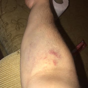 Türk Kızılay Kan Bağışı Sonucu Kolumda Anormal Morarma!