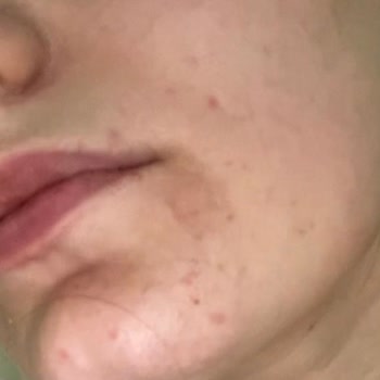 Bioderma Foaming Gel Sivilce Çıkarttı!