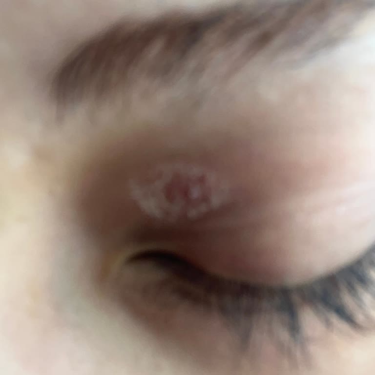 Gratis Close İt Tahriş