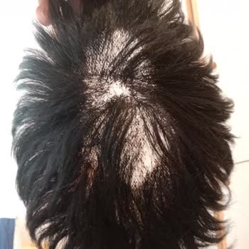 Konya Protez Saç Ali Yıldız Hayal Kırıklığına Uğratan Protez Saç Deneyimi