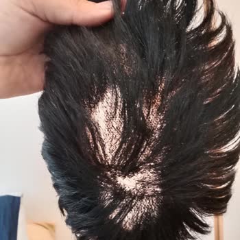 Konya Protez Saç Ali Yıldız Hayal Kırıklığına Uğratan Protez Saç Deneyimi