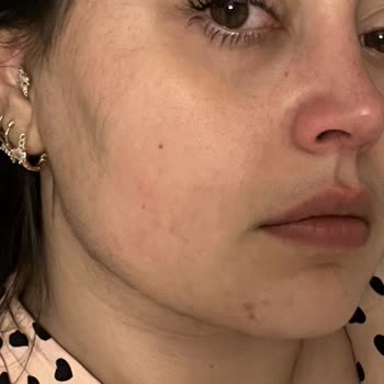 Aris Güzellik Merkezleri VIP Güzellik Merkezinde Yaşanan Epilasyon Problemleri