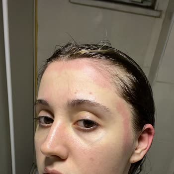 Severe Reaction to Sebamed Anti-Hair Loss Shampoo