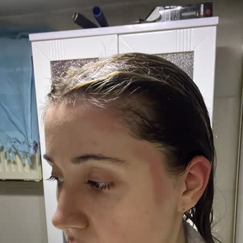 Severe Reaction to Sebamed Anti-Hair Loss Shampoo