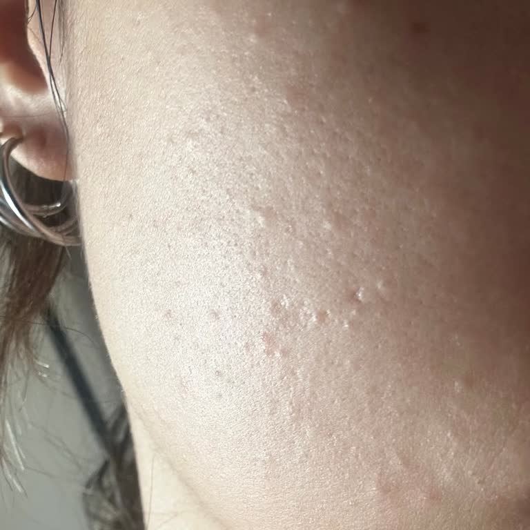 Bioderma Yüz Yıkama Jeli Ve Hyaluronik Asidi Komedon Yaptı