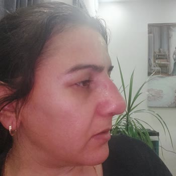 Op. Dr. Uğur Harputluoğlu Burun Estetiği Sonucu Hüsran