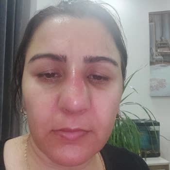 Op. Dr. Uğur Harputluoğlu Burun Estetiği Sonucu Hüsran