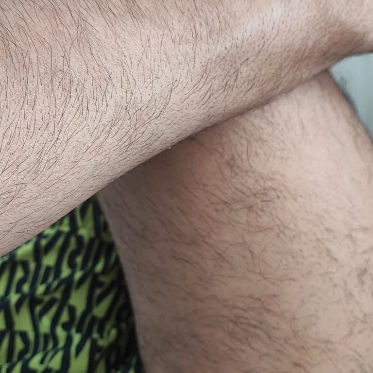 Enza Güzellik Merkezleri Lazer Epilasyon Sonrası Memnuniyetsizlik