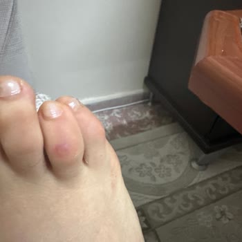 Hotiç Ayakkabı Ayağımı Vurdu, Yardımcı Olmadılar.