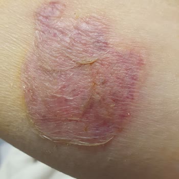 Sevgi Medlife Estetik Ankara Ems Cihazıyla Kolumu Yaktı