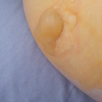 Sevgi Medlife Estetik Ankara Ems Cihazıyla Kolumu Yaktı