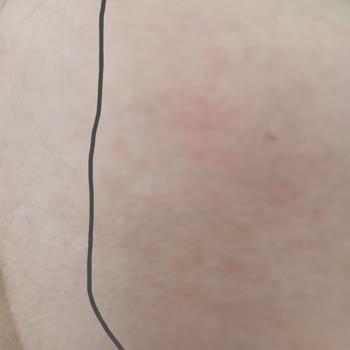 Koreaco Serumları Leke Yaptı