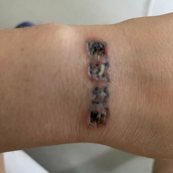 Unest_guzellik (Instagram) Dövme Silme Yanık Sorunu
