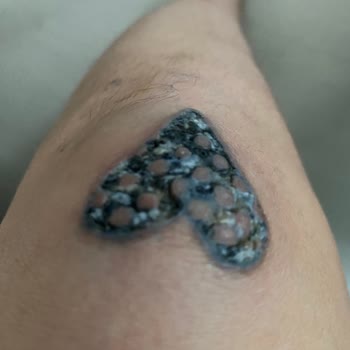 Unest_guzellik (Instagram) Dövme Silme Yanık Sorunu