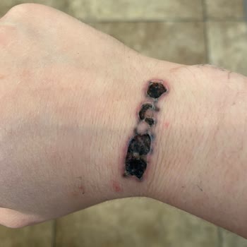 Unest_guzellik (Instagram) Dövme Silme Yanık Sorunu