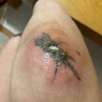 Unest_guzellik (Instagram) Dövme Silme Yanık Sorunu