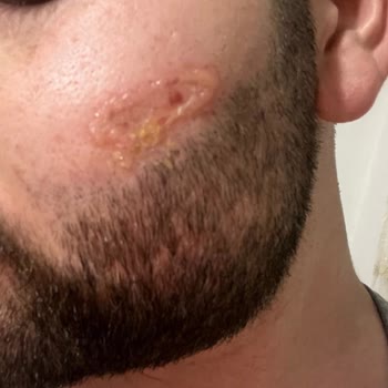 Bbd Business Güzellik Merkezi Keçiören Keçiören Şubesinde Yüzümü Yaktılar