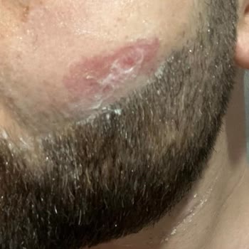 Bbd Business Güzellik Merkezi Keçiören Keçiören Şubesinde Yüzümü Yaktılar