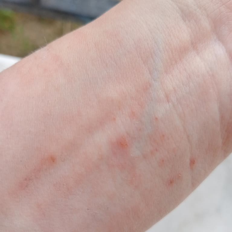 Huawei Akıllı Saatim Alerji Yapıyor Kolumu Çok Rahatsız Ediyor