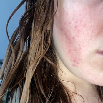 The Purest Solutions Cildim Yandı Ve Sivilcelendi