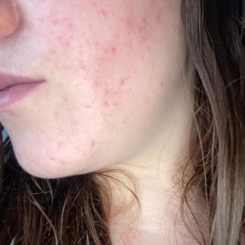 The Purest Solutions Cildim Yandı Ve Sivilcelendi