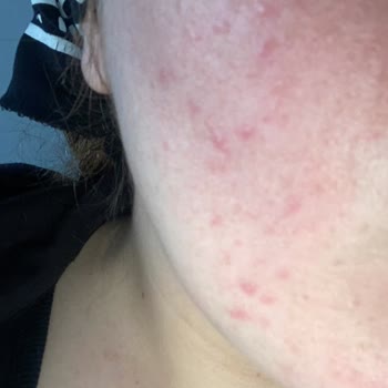 The Purest Solutions Cildim Yandı Ve Sivilcelendi