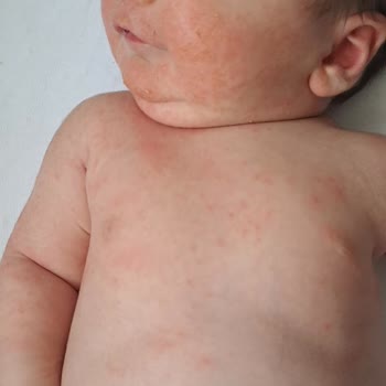 Mustela Bebeğimi Cildini Tahriş Etti.