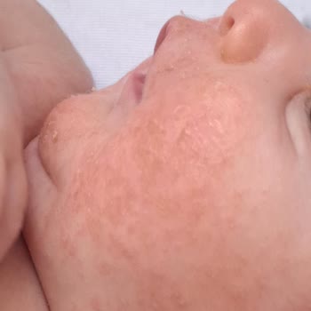 Mustela Bebeğimi Cildini Tahriş Etti.