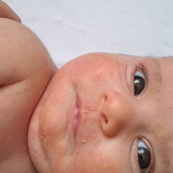 Mustela Bebeğimi Cildini Tahriş Etti.