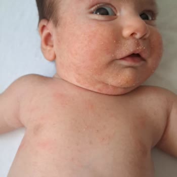 Mustela Bebeğimi Cildini Tahriş Etti.