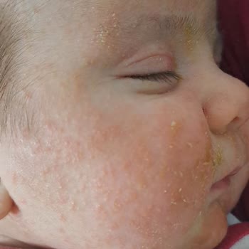 Mustela Bebeğimi Cildini Tahriş Etti.