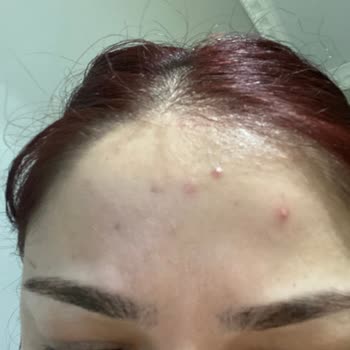 New Well Yüzümde Oluşan Büyük Sivilceler