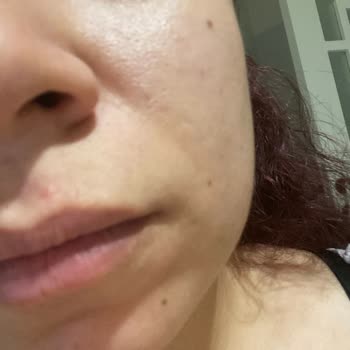 New Well Yüzümde Oluşan Büyük Sivilceler