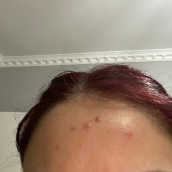 New Well Yüzümde Oluşan Büyük Sivilceler