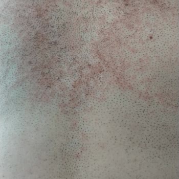 Bioder Vücudumu Yaktı Beni Mahvetti